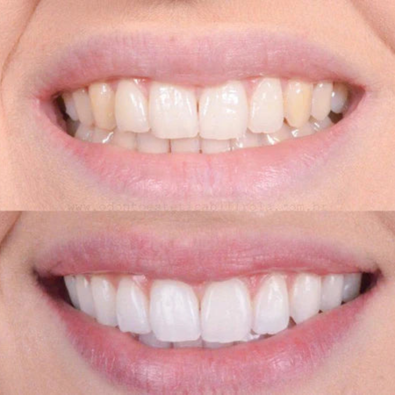 PearlWhite – Clareamento Rápido dos Dentes Para um Sorriso Radiante